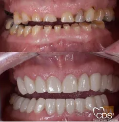 نمونه کار Tüm çənə implant-estetika در تبریز - 3