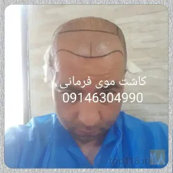 نمونه کار بهترین کاشت مو در تبریز  کاشت موی فرمانی در تبریز - 3