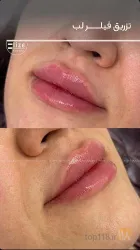 نمونه کار پوست و مو و لیزر الیزه در تبریز - 3