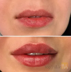 نمونه کار بهترین مطب زیبایی بوتاکس و ژل در تبریز در تبریز - 3
