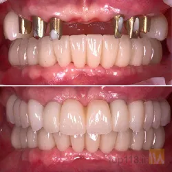 نمونه کار کلینیک  تخصصی دندانپزشکی مروارید در تبریز - 3
