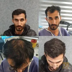 نمونه کار  کاشت مو ایمانی در تبریز - 2