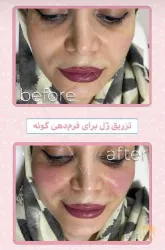 نمونه کار مرکز لیزر برفین در تبریز - 3