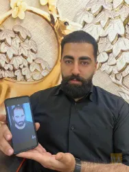 نمونه کار کاشت مو تخصصی در تبریز - 3