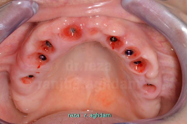 Tüm çənə implant-estetika در تبریز İmplant və gülüş uygulaması در تبریز