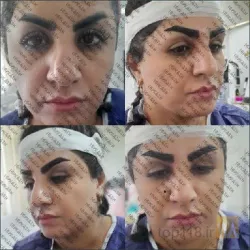 نمونه کار بهترین کاشت ابرو در تبریز کاشت ابروی باقری در تبریز - 4