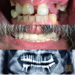 نمونه کار مطب دندانپزشکی دکتر وحید قاسم زاده در تبریز - 4