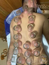 نمونه کار حجامت در شیراز در شیراز - 4