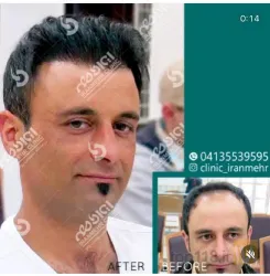 نمونه کار درمانگاه کاشت موی ایران مهر  در تبریز - 4