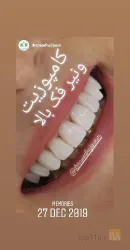 نمونه کار دندانپزشکی دکتر سعید حاجی پور  در تبریز - 4