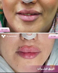 نمونه کار پوست مو و زیبایی لیزر دکتر مریم پناهزاده در تبریز - 4