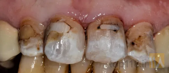 نمونه کار دکتر رضا رنجبر اقدم   ایمپلنت تمام فک- طرح لبخند متناسب با صورت- لمینیت-کامپوزیت در تبریز - 4