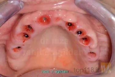 نمونه کار Tüm çənə implant-estetika در تبریز - 4