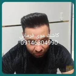 نمونه کار بهترین کاشت مو در تبریز  کاشت موی فرمانی در تبریز - 4