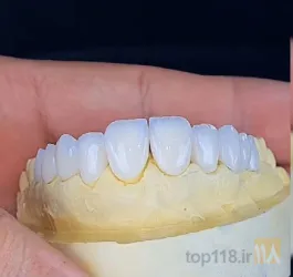 نمونه کار لابراتوار دندانپزشکی دنتال پلاس در تبریز - 4