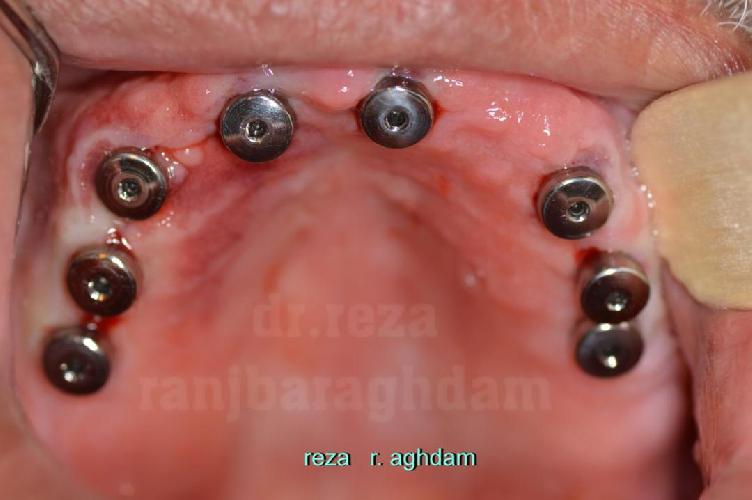 Tüm çənə implant-estetika در تبریز İmplant və gülüş uygulaması در تبریز