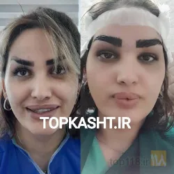 نمونه کار بهترین کاشت ابرو در تبریز کاشت ابروی باقری در تبریز - 5