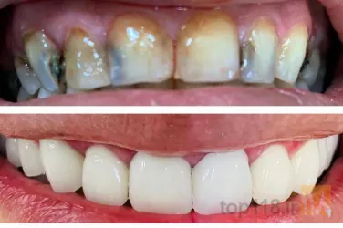 نمونه کار مطب دندانپزشکی دکتر وحید قاسم زاده در تبریز - 5