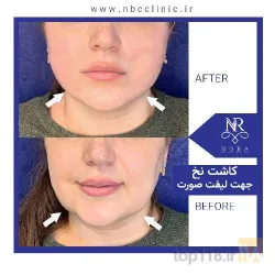 نمونه کار بهترین لیفت با نخ در تبریز - 5