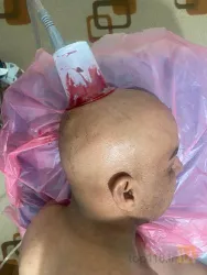 نمونه کار حجامت در شیراز در شیراز - 5