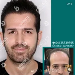 نمونه کار درمانگاه کاشت موی ایران مهر  در تبریز - 5