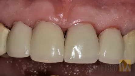 نمونه کار دکتر رضا رنجبر اقدم   ایمپلنت تمام فک- طرح لبخند متناسب با صورت- لمینیت-کامپوزیت در تبریز - 5