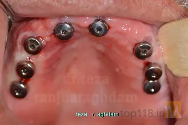 نمونه کار Tüm çənə implant-estetika در تبریز - 5