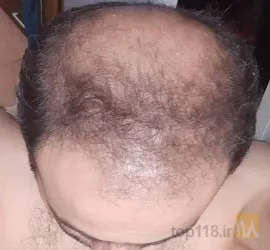 نمونه کار بهترین کاشت مو در تبریز  کاشت موی فرمانی در تبریز - 5