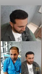 نمونه کار  کاشت مو ایمانی در تبریز - 4