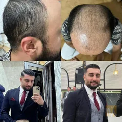 نمونه کار کاشت مو تخصصی در تبریز - 5