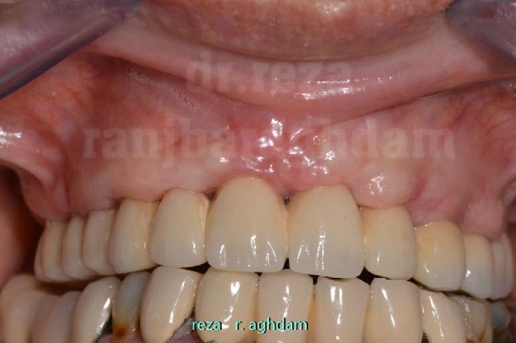 Tüm çənə implant-estetika در تبریز İmplant və gülüş uygulaması در تبریز