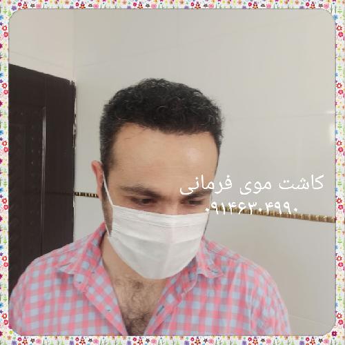 بهترین کاشت مو در تبریز کاشت موی فرمانی در تبریز کاشت مو در تبریز