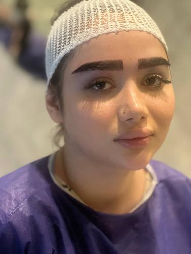 کاشت موی تخصصی ایمانی در تبریز