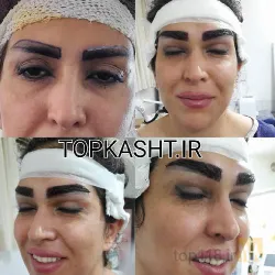 نمونه کار بهترین کاشت ابرو در تبریز کاشت ابروی باقری در تبریز - 6