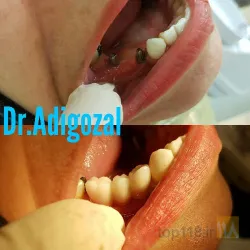 نمونه کار دندانپزشکی دکتر آدی گوزل در تبریز - 6
