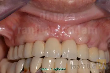 نمونه کار Tüm çənə implant-estetika در تبریز - 6