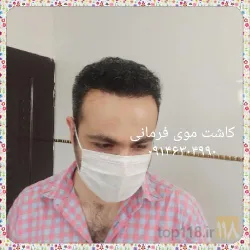 نمونه کار بهترین کاشت مو در تبریز  کاشت موی فرمانی در تبریز - 6