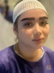 نمونه کار  کاشت مو ایمانی در تبریز - 5