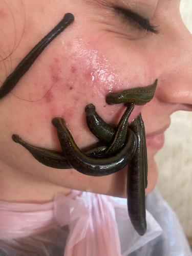حجامت در شیراز در شیراز حجامت - طب سنتی در شیراز