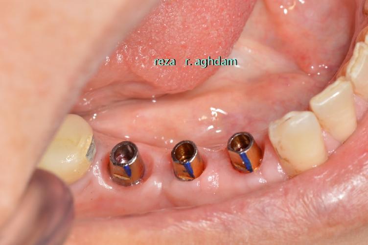 Tüm çənə implant-estetika در تبریز İmplant və gülüş uygulaması در تبریز