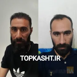 نمونه کار بهترین کاشت ابرو در تبریز کاشت ابروی باقری در تبریز - 7