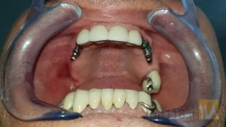 نمونه کار دکتر رضا رنجبر اقدم   ایمپلنت تمام فک- طرح لبخند متناسب با صورت- لمینیت-کامپوزیت در تبریز - 7