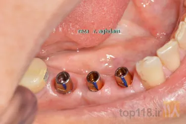 نمونه کار Tüm çənə implant-estetika در تبریز - 7