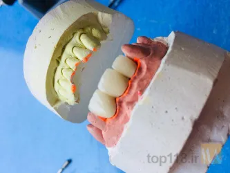 نمونه کار لابراتوار دندانپزشکی دنتال پلاس در تبریز - 6