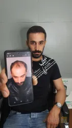 نمونه کار کلینیک تخصصی کاشت موی رحیمی در تبریز - 6