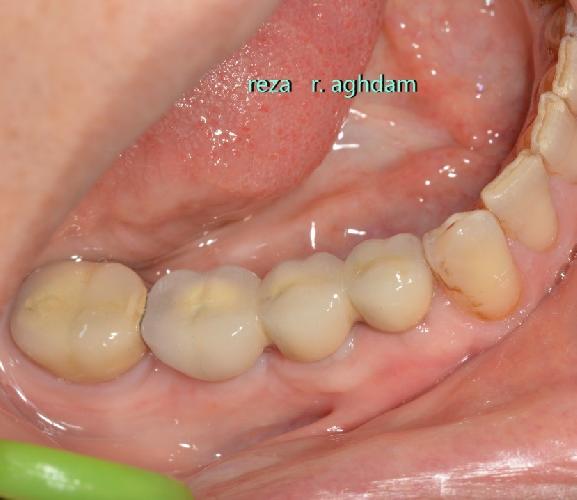 Tüm çənə implant-estetika در تبریز İmplant və gülüş uygulaması در تبریز