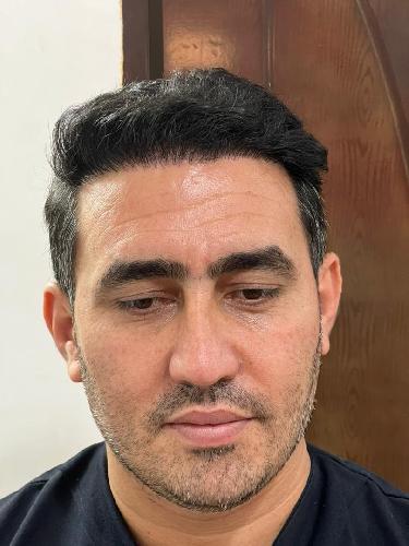 کاشت موی تخصصی ایمانی در تبریز