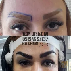 نمونه کار بهترین کاشت ابرو در تبریز کاشت ابروی باقری در تبریز - 8