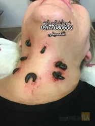 نمونه کار حجامت در شیراز در شیراز - 7