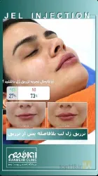 نمونه کار درمانگاه کاشت موی ایران مهر  در تبریز - 8